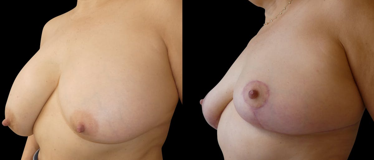 Breast Lift Before & After Gallery - Patient 252247 - Image 3