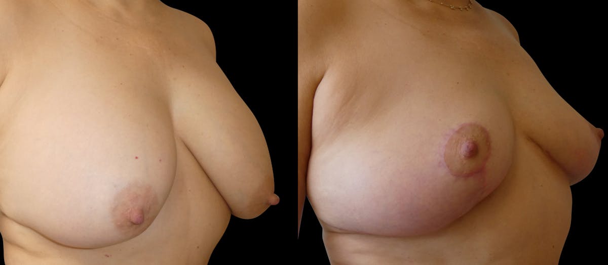 Breast Lift Before & After Gallery - Patient 252247 - Image 2