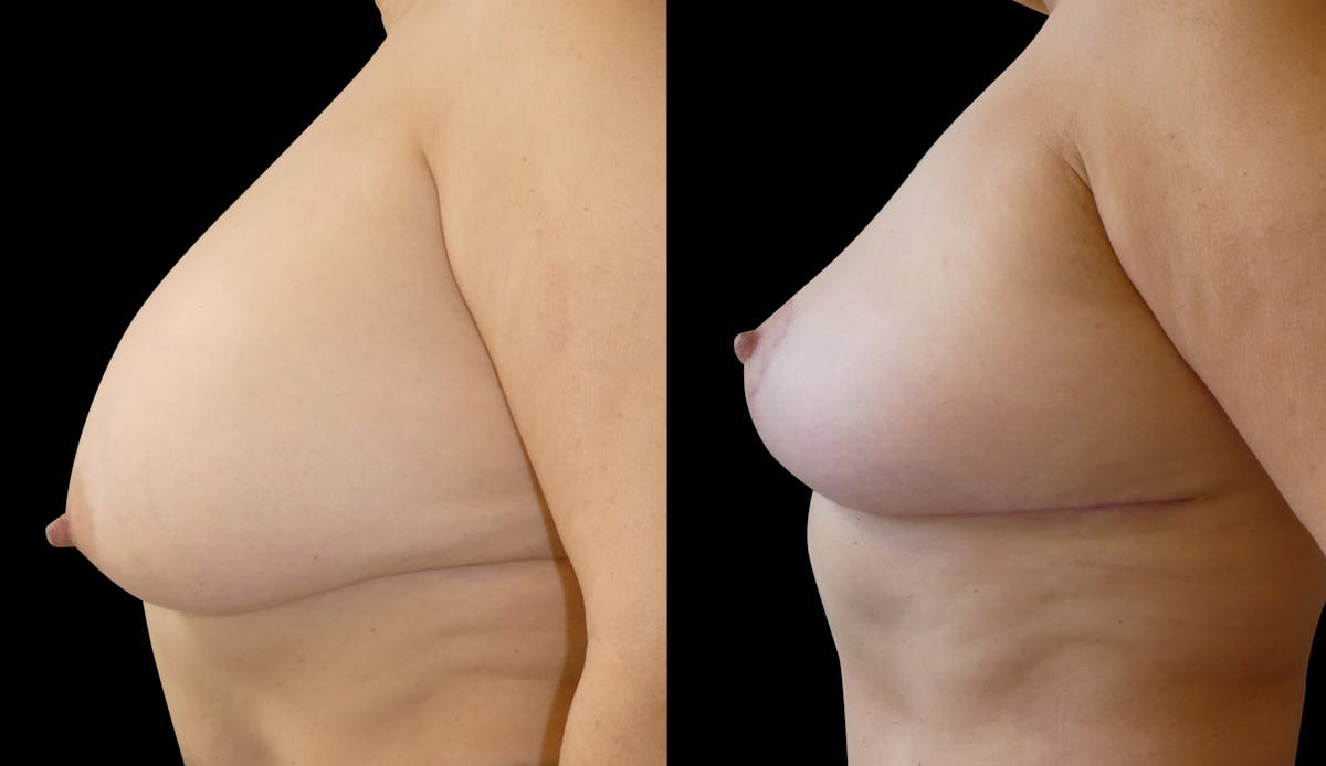 Breast Lift Before & After Gallery - Patient 252247 - Image 5