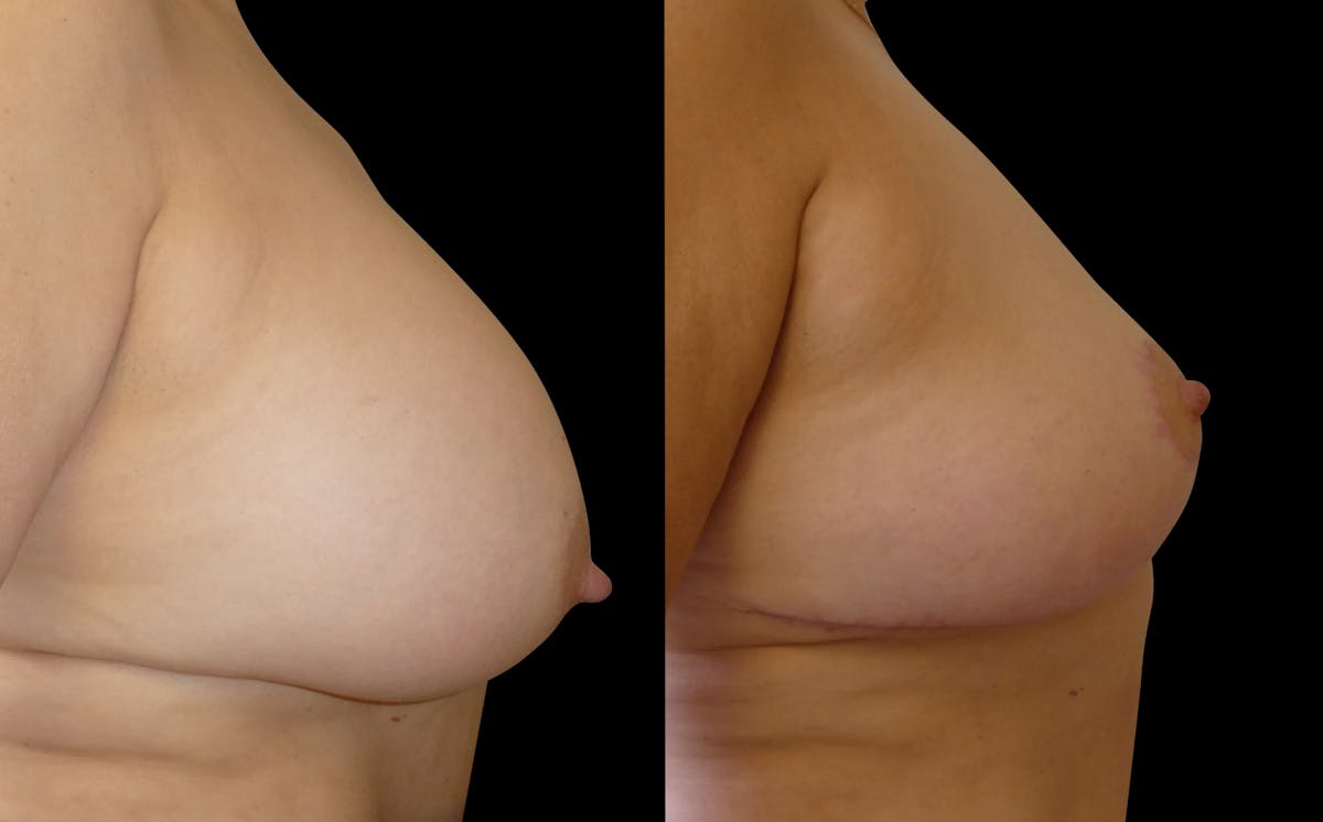 Breast Lift Before & After Gallery - Patient 252247 - Image 4