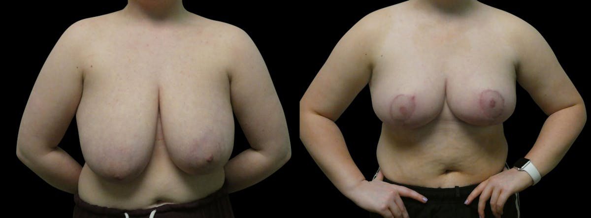 Breast Reduction Before & After Gallery - Patient 245125 - Image 1