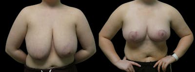 Breast Reduction + Lift Before & After Gallery - Patient 239670 - Image 1