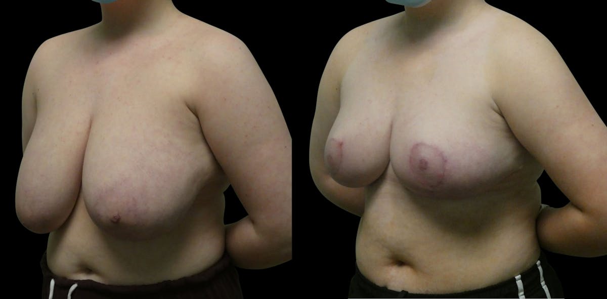 Breast Reduction Before & After Gallery - Patient 245125 - Image 5