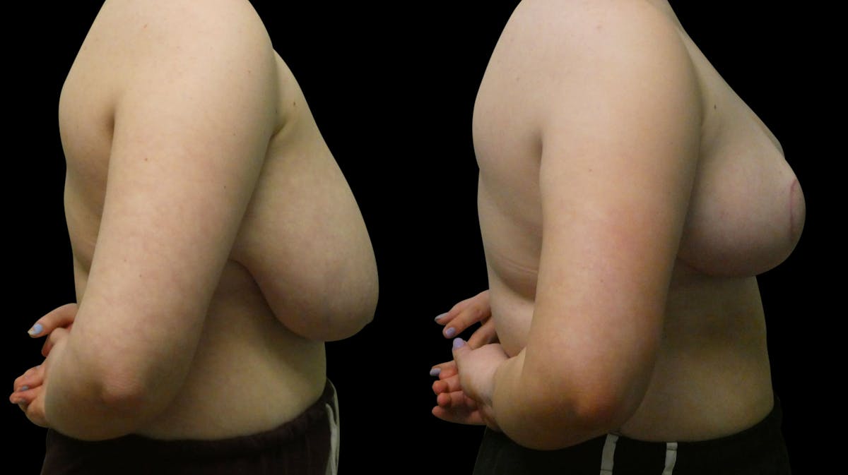 Breast Reduction Before & After Gallery - Patient 245125 - Image 4