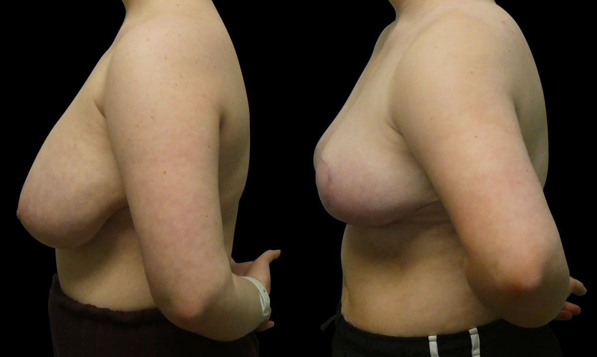 Breast Reduction Before & After Gallery - Patient 245125 - Image 3