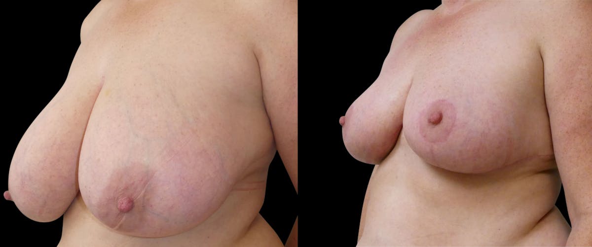 Breast Reduction Before & After Gallery - Patient 202514 - Image 2