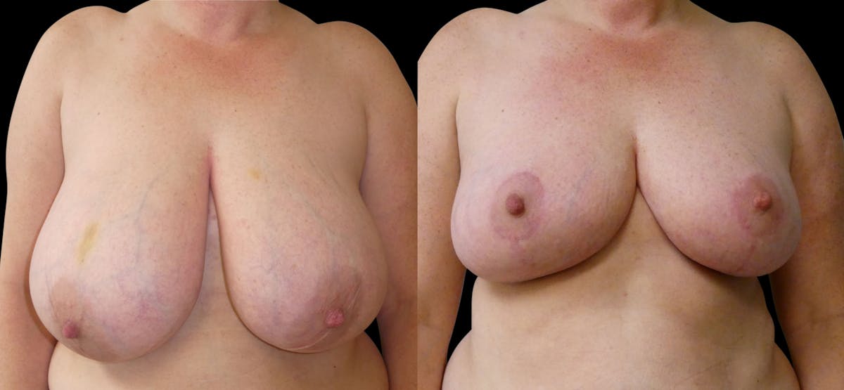 Breast Reduction Before & After Gallery - Patient 202514 - Image 1