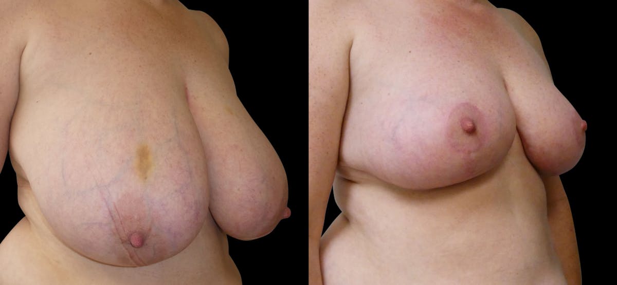 Breast Reduction Before & After Gallery - Patient 202514 - Image 3