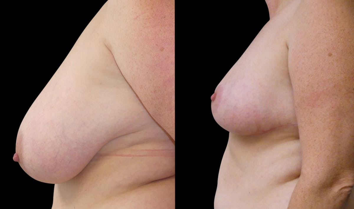 Breast Reduction Before & After Gallery - Patient 202514 - Image 4