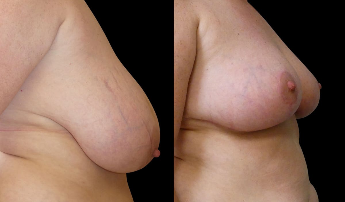 Breast Reduction Before & After Gallery - Patient 202514 - Image 5