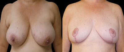 Breast Reduction + Lift Before & After Gallery - Patient 274233 - Image 1