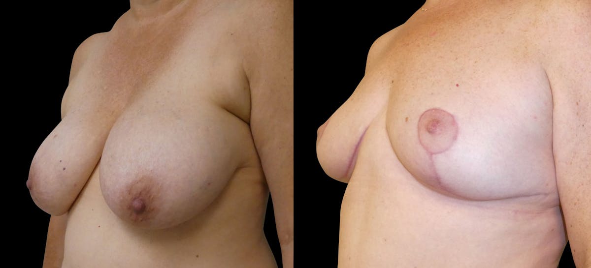 Breast Reduction Before & After Gallery - Patient 563471 - Image 2