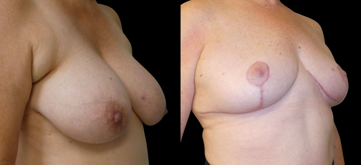Breast Reduction Before & After Gallery - Patient 563471 - Image 3