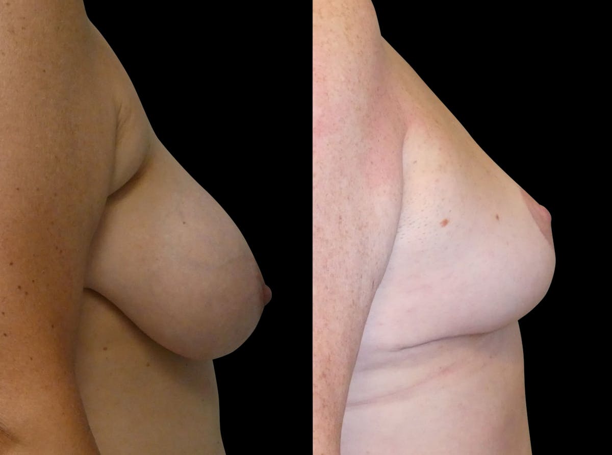Breast Reduction Before & After Gallery - Patient 563471 - Image 4