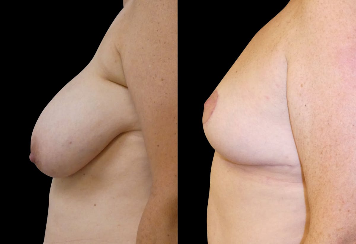 Breast Reduction Before & After Gallery - Patient 563471 - Image 5