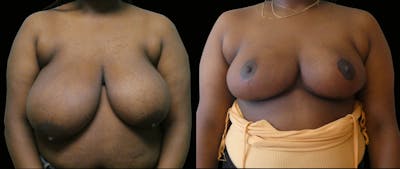 Breast Reduction + Lift Before & After Gallery - Patient 127103 - Image 1