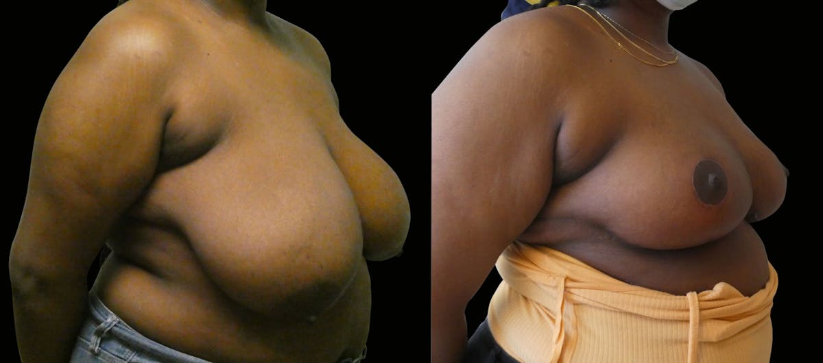 Breast Reduction Before & After Gallery - Patient 301547 - Image 4