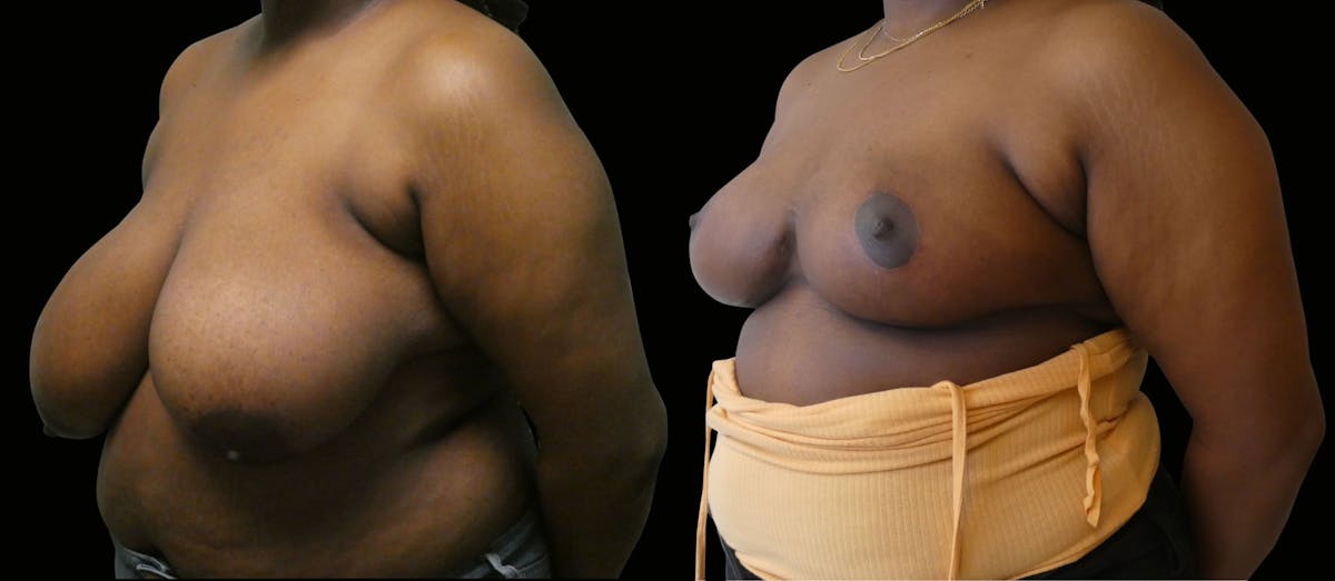 Breast Reduction Before & After Gallery - Patient 301547 - Image 2