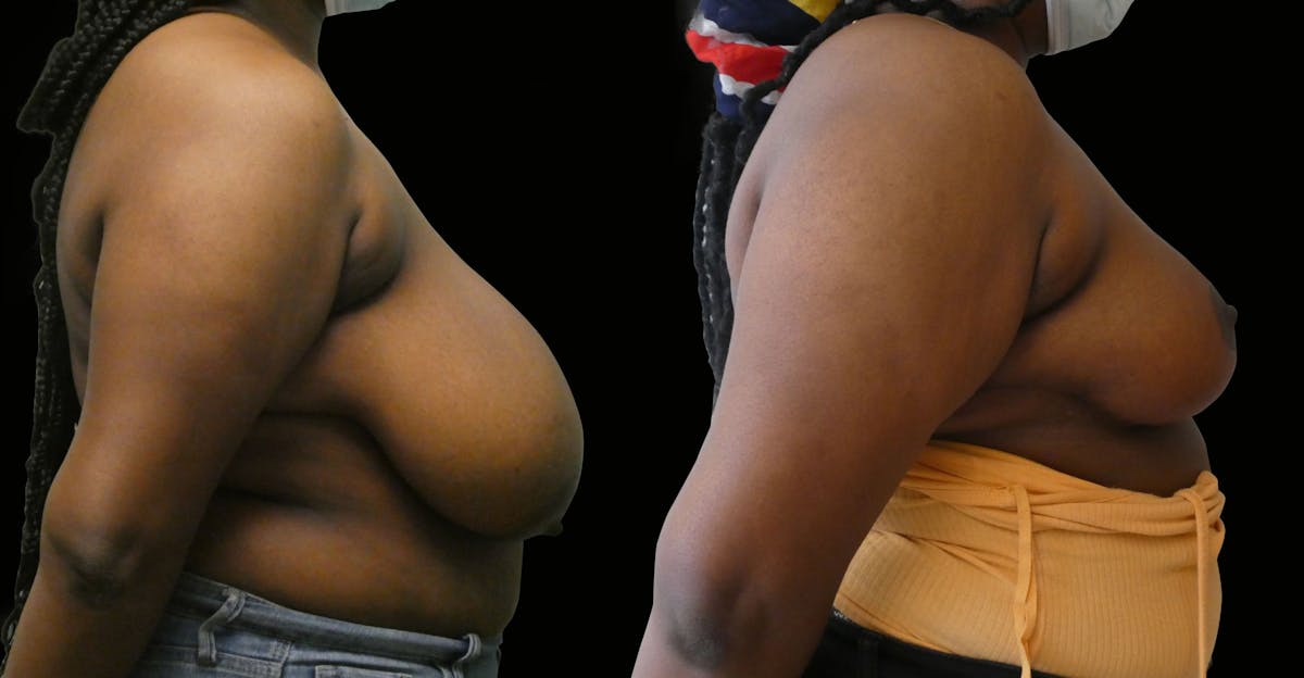 Breast Reduction Before & After Gallery - Patient 301547 - Image 3