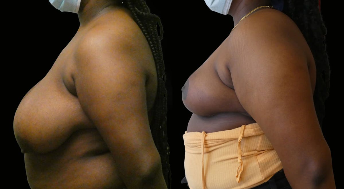 Breast Reduction Before & After Gallery - Patient 301547 - Image 5