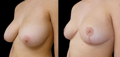 Breast Reduction + Lift Before & After Gallery - Patient 222970 - Image 1
