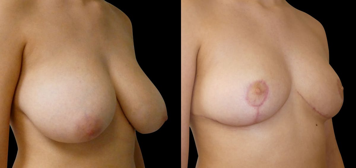 Breast Reduction Before & After Gallery - Patient 260879 - Image 5