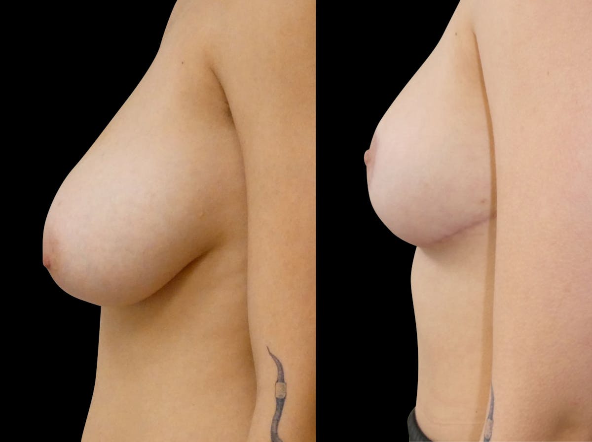 Breast Reduction Before & After Gallery - Patient 260879 - Image 2