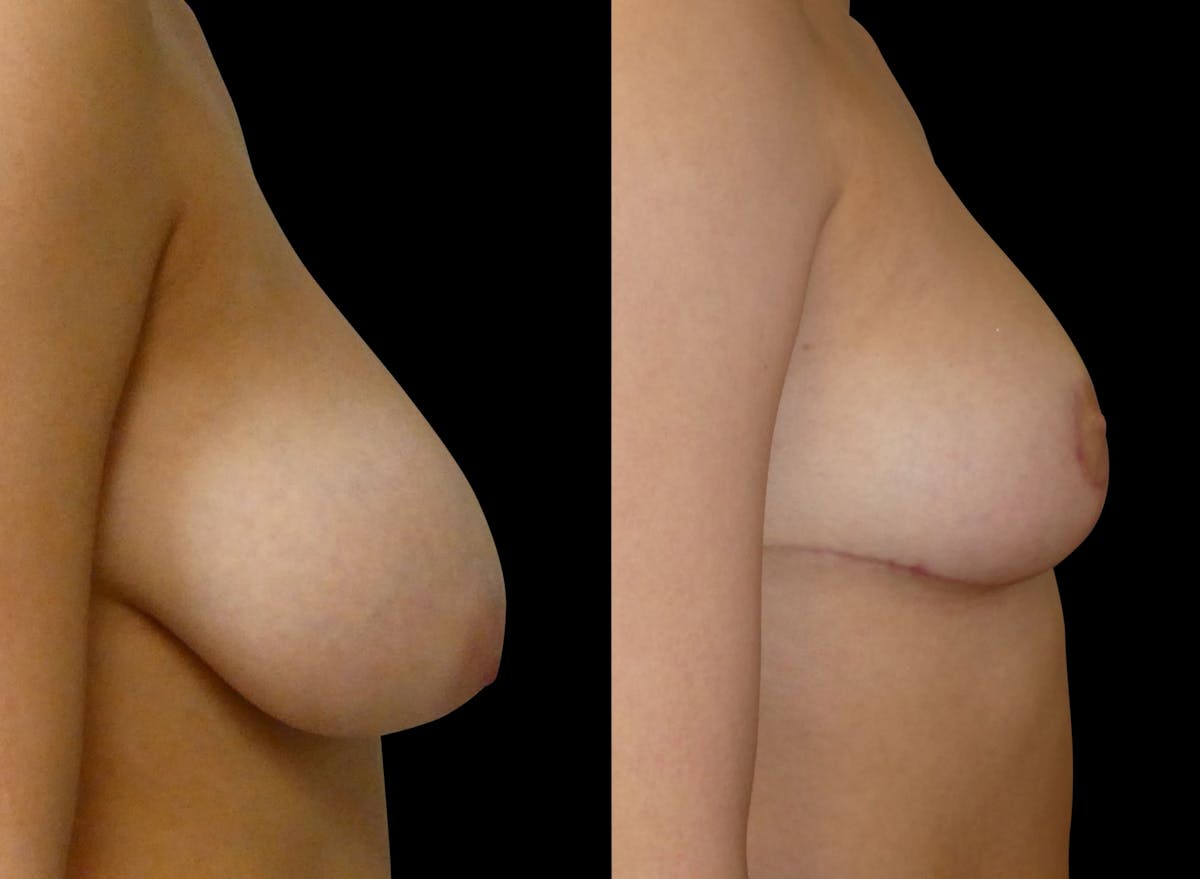 Breast Reduction Before & After Gallery - Patient 260879 - Image 3