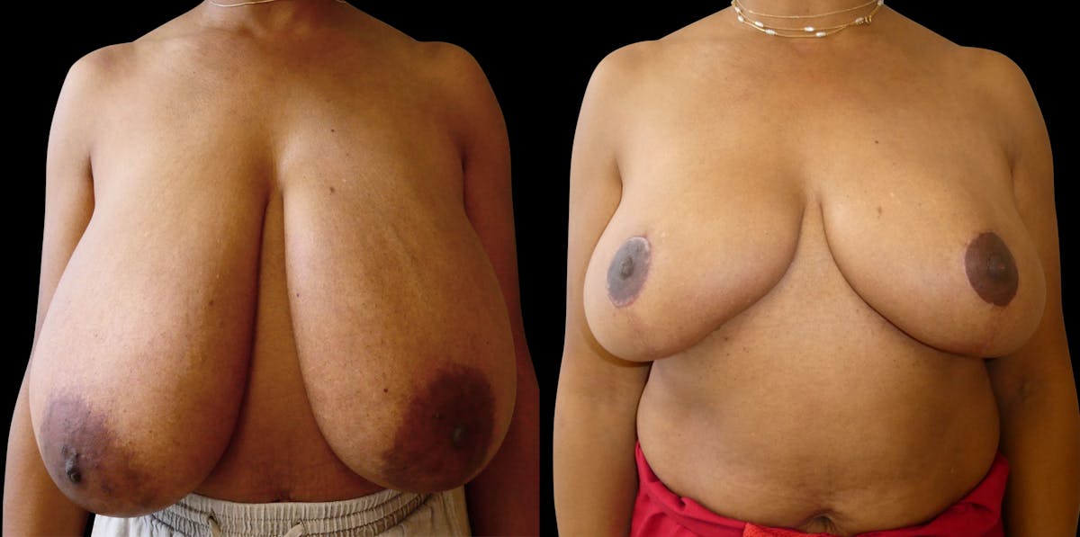 Breast Reduction Before & After Gallery - Patient 214893 - Image 1