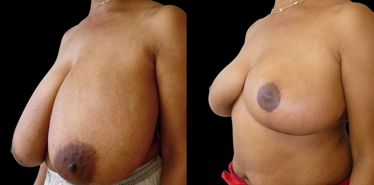 Breast Reduction Before & After Gallery - Patient 214893 - Image 3