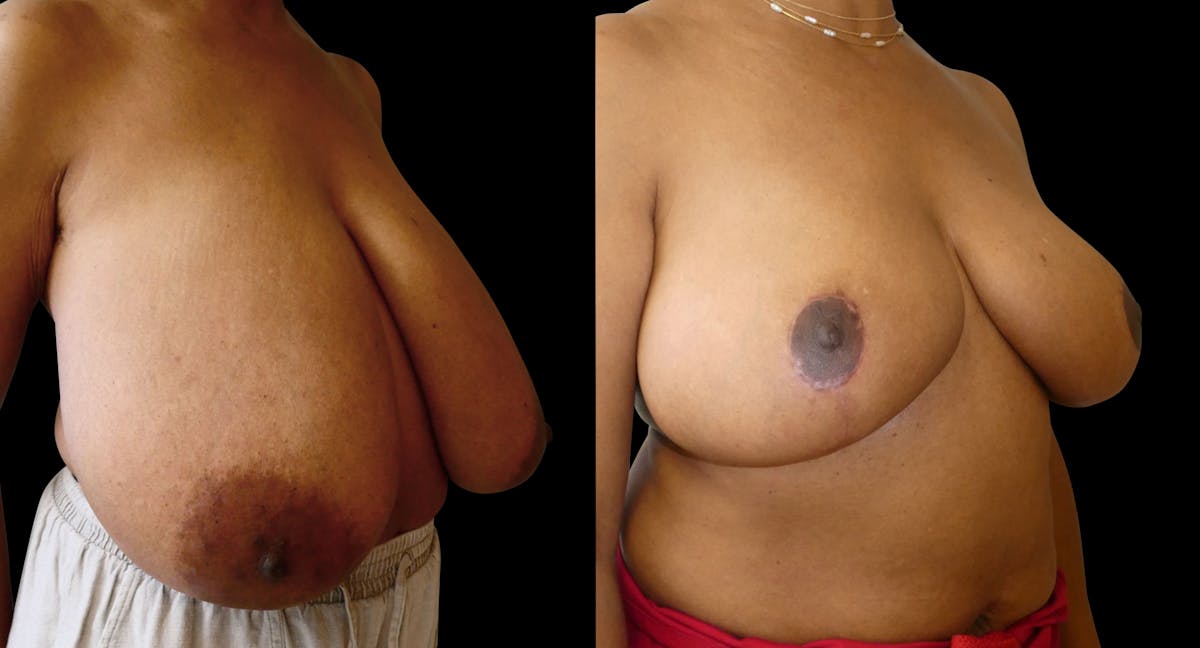 Breast Reduction Before & After Gallery - Patient 214893 - Image 2