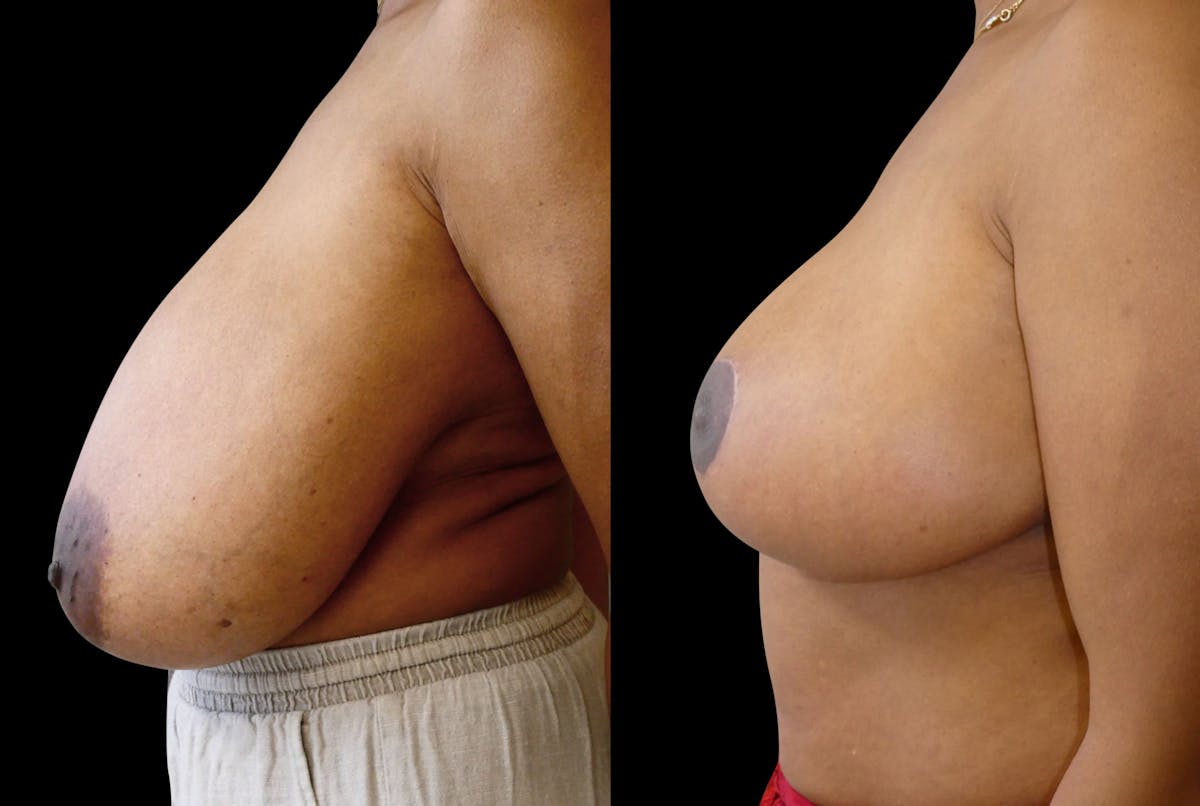 Breast Reduction Before & After Gallery - Patient 214893 - Image 4