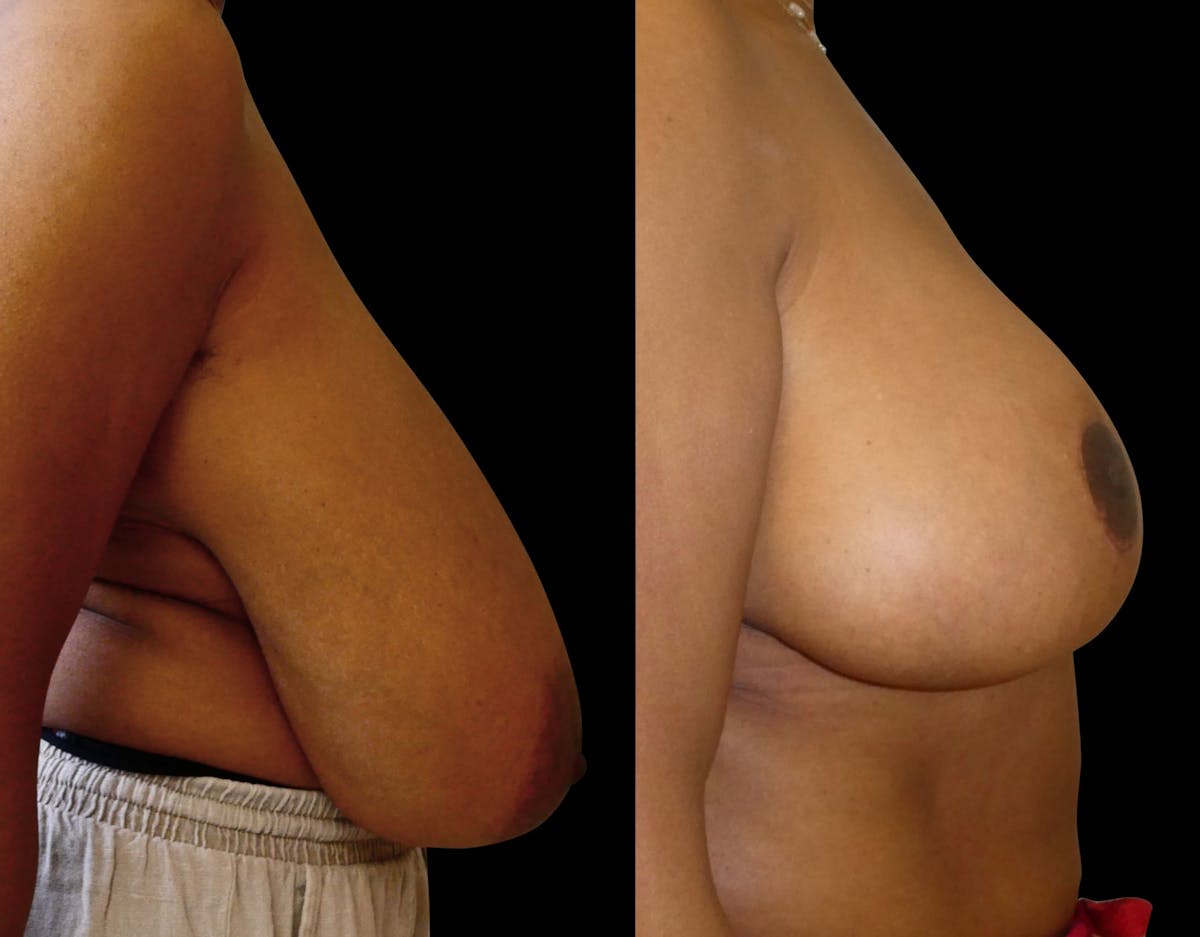 Breast Reduction Before & After Gallery - Patient 214893 - Image 5