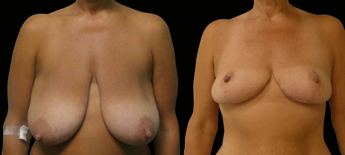 Breast Reduction Before & After Gallery - Patient 202718 - Image 1