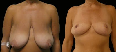 Breast Reduction Before & After Gallery - Patient 202718 - Image 1
