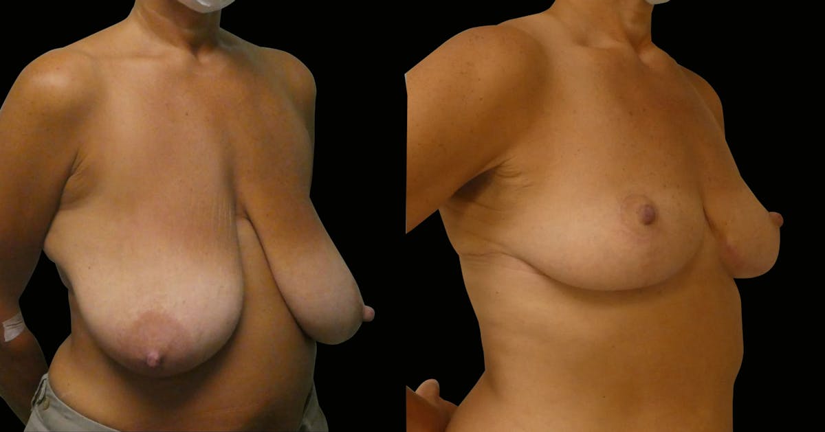 Breast Reduction Before & After Gallery - Patient 202718 - Image 2