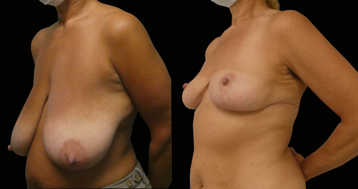 Breast Reduction Before & After Gallery - Patient 202718 - Image 3