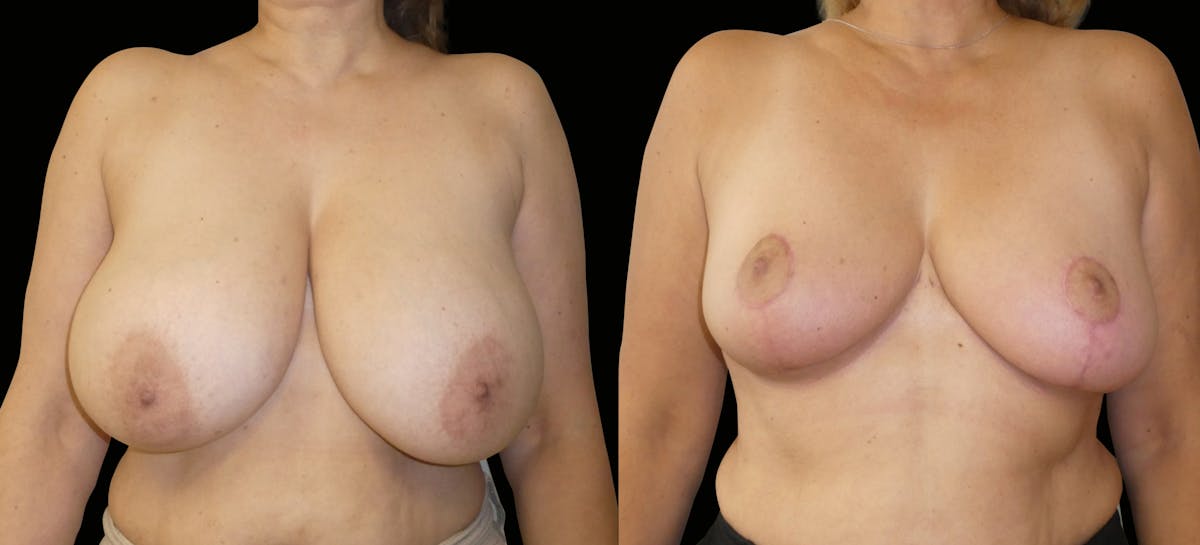 Breast Reduction Before & After Gallery - Patient 129437 - Image 1