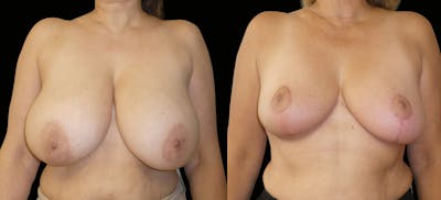 Breast Reduction Before & After Gallery - Patient 129437 - Image 1