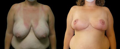 Breast Reduction Before & After Gallery - Patient 302869 - Image 1