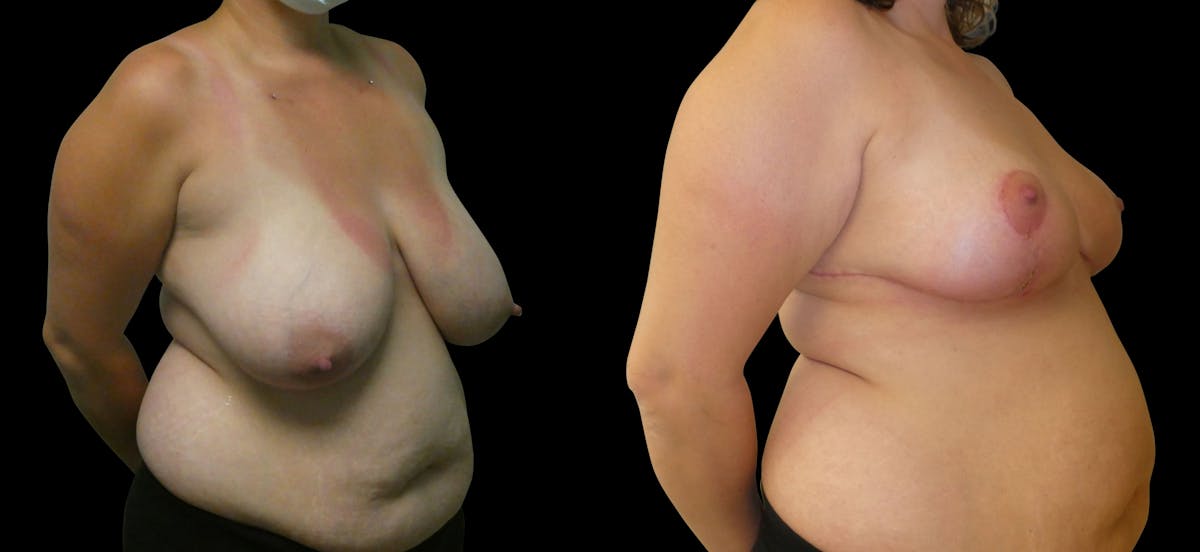 Breast Reduction Before & After Gallery - Patient 302869 - Image 2