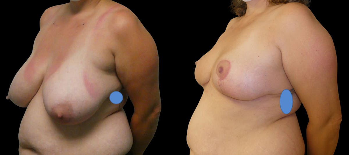 Breast Reduction Before & After Gallery - Patient 302869 - Image 3