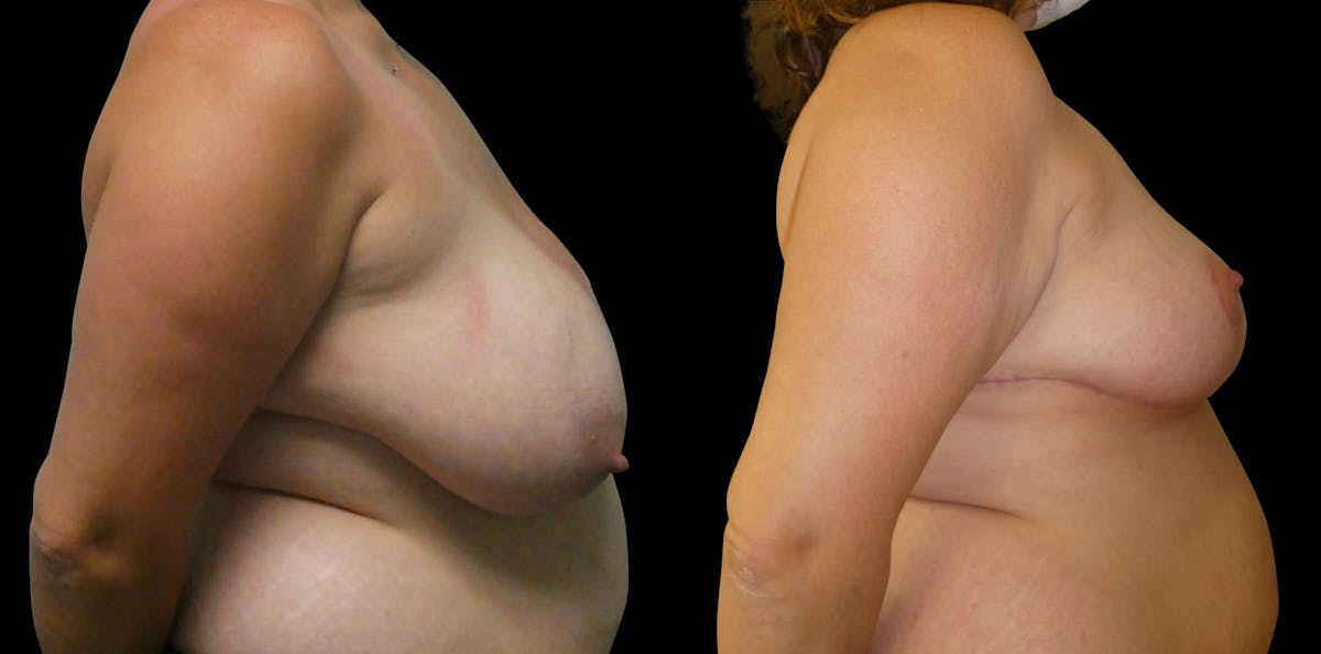 Breast Reduction Before & After Gallery - Patient 302869 - Image 4