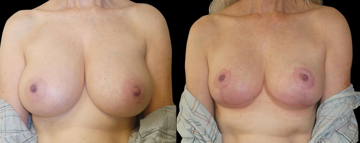 Breast Reduction Before & After Gallery - Patient 246003 - Image 1