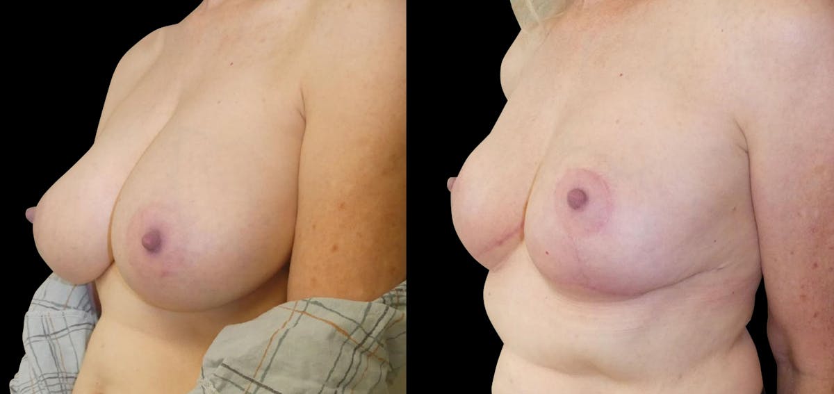 Breast Reduction Before & After Gallery - Patient 246003 - Image 3