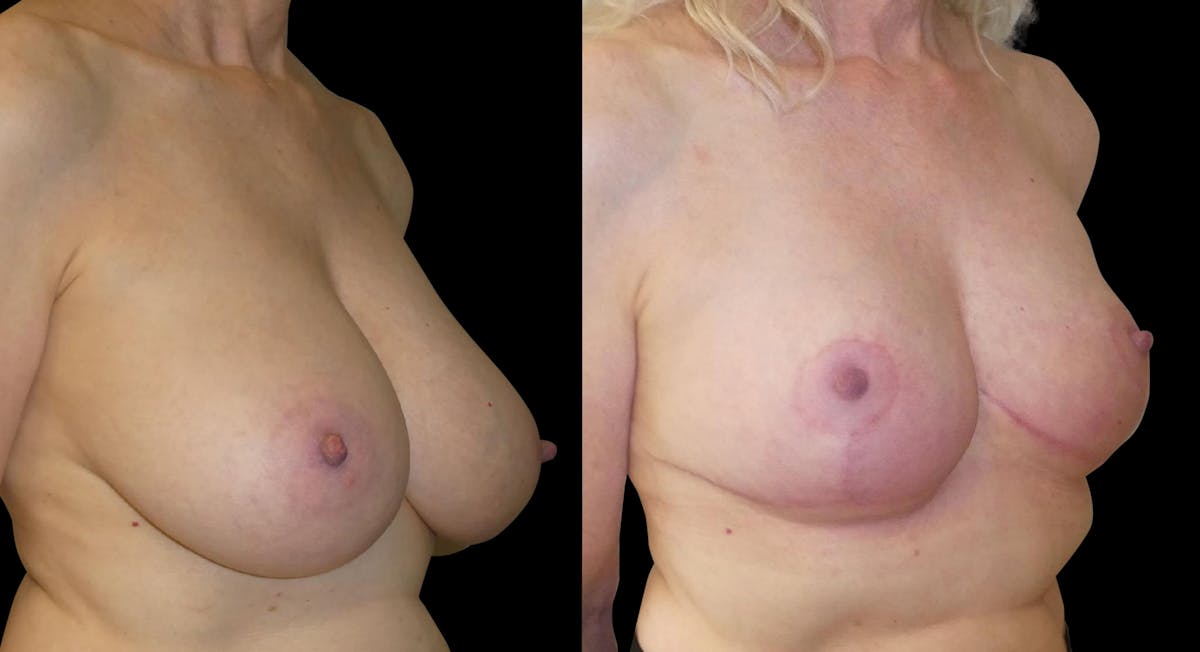 Breast Reduction Before & After Gallery - Patient 246003 - Image 2