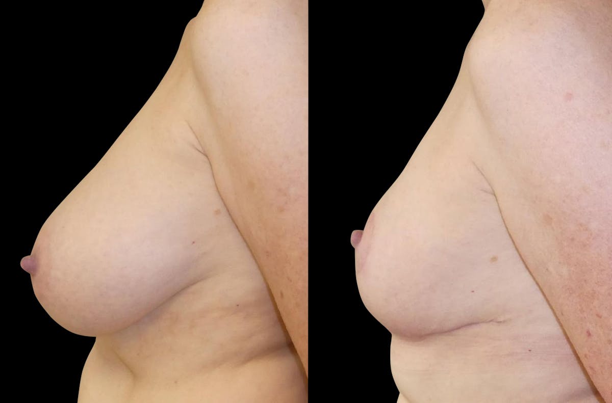 Breast Reduction Before & After Gallery - Patient 246003 - Image 4
