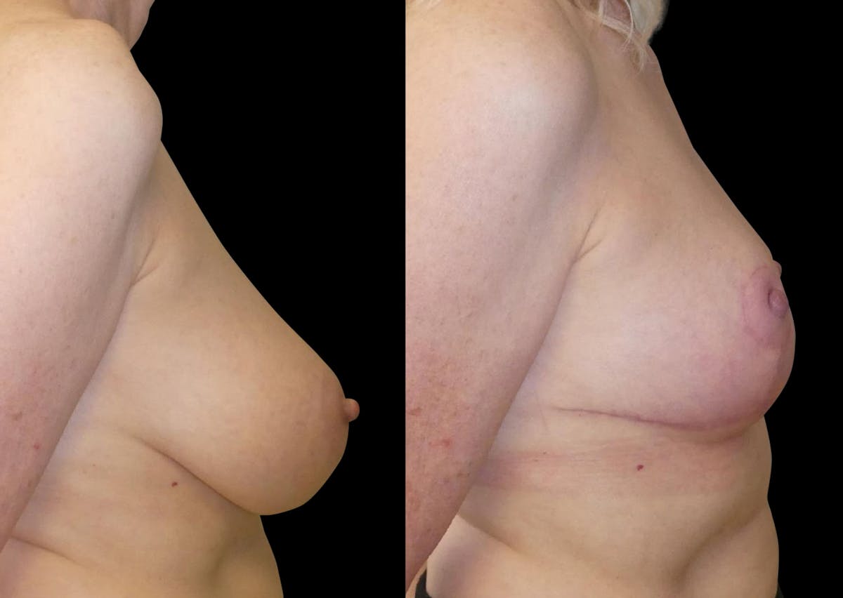 Breast Reduction Before & After Gallery - Patient 246003 - Image 5