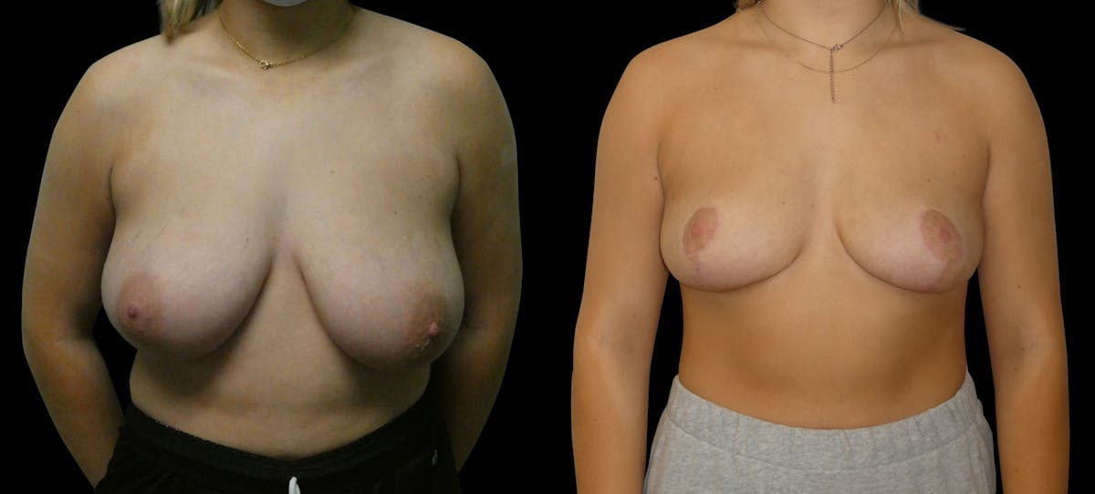 Breast Reduction Before & After Gallery - Patient 547442 - Image 1