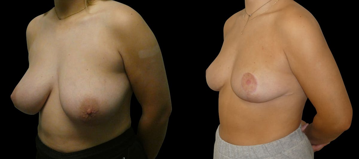 Breast Reduction Before & After Gallery - Patient 547442 - Image 3
